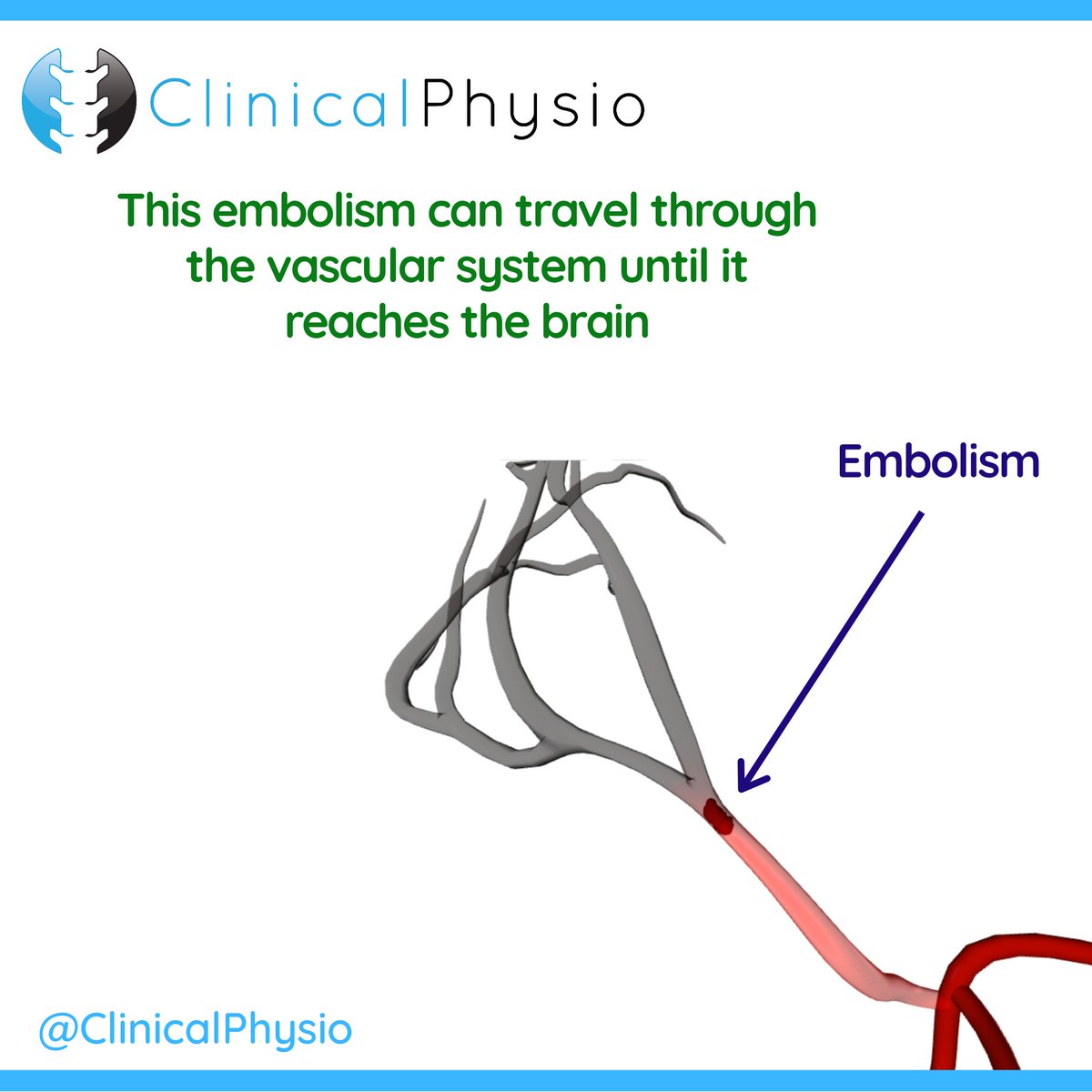 clinicalphysio's tweet photo. 💥 WHAT YOU NEED TO KNOW ABOUT EMBOLIC STROKES 💥
#stroke #strokephysio #neurophysio #strokerehab #cva #neurology https://t.co/pG5waa2QqA
