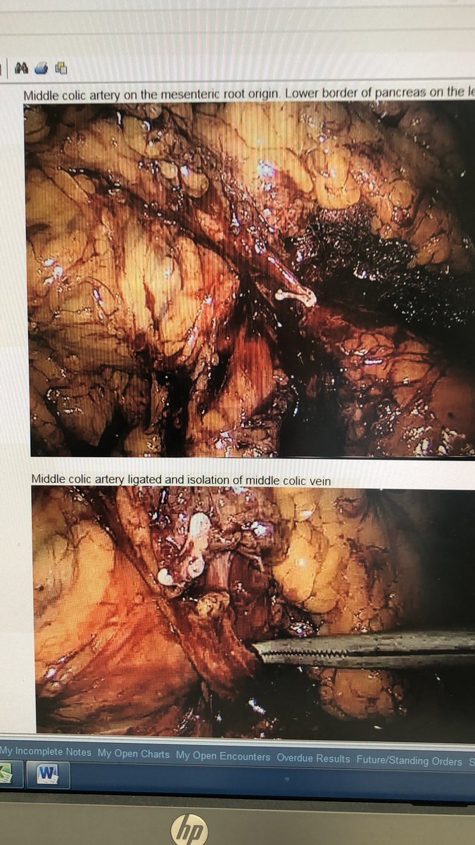 salo75's tweet photo. @SWexner Sure extended right colectomy without doubts. Here another case of lap extended right with transverse mesocolic excision & IC ileodescending anastomosis Iβve done @CUH_NHS & presented by one of my trainees @ASCRS_1 #ascrs2020 https://t.co/bQrSGD0PS8
