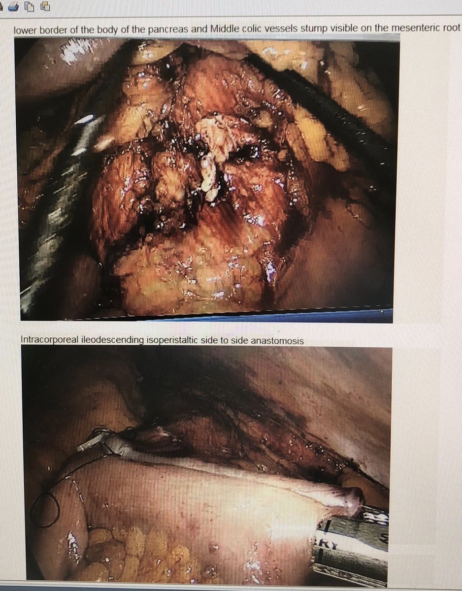 salo75's tweet photo. @SWexner Sure extended right colectomy without doubts. Here another case of lap extended right with transverse mesocolic excision & IC ileodescending anastomosis Iβve done @CUH_NHS & presented by one of my trainees @ASCRS_1 #ascrs2020 https://t.co/bQrSGD0PS8
