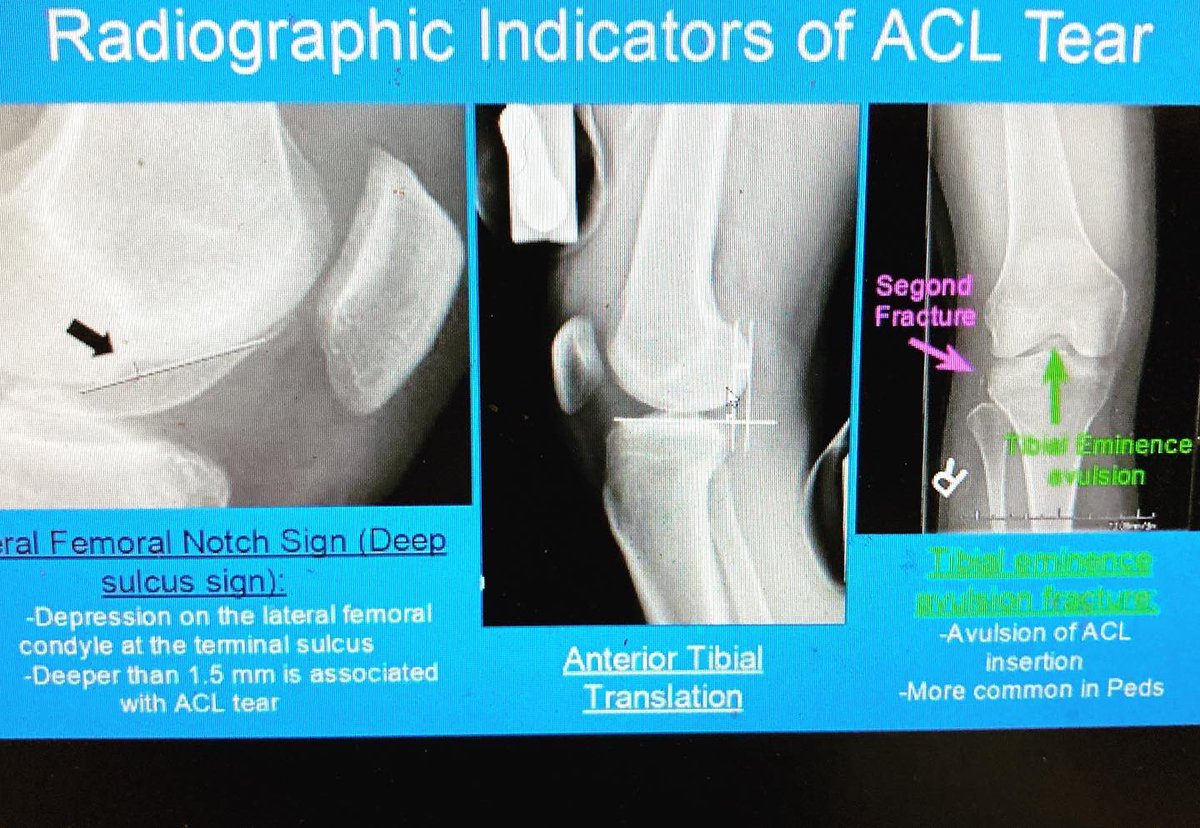 What a great morning at our U of A Department or Orthopedic Surgery's Grand Rounds with a multidisciplinary presentation on ACL injuries.  This included athletic trainers, orthopedic surgeons and physicians, radiologists and physical therapists!!!  #orthopedics
