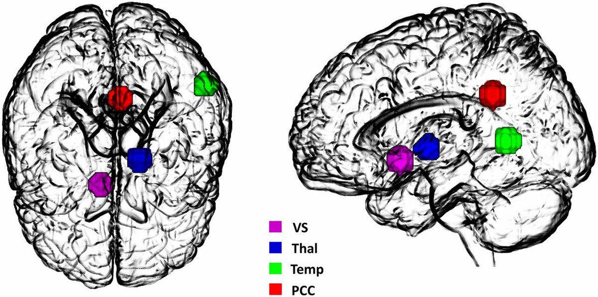 MicrodoseHQ's tweet photo. #Psychedelics offer the unique opportunity to investigate the neuropharmacological and mechanistic underpinnings of perception, thought, and #consciousness.
Scans show LSD’s ability to facilitate effective connectivity changes in the #brain
#nextgenerationmedicine https://t.co/8faLFu6fXe
