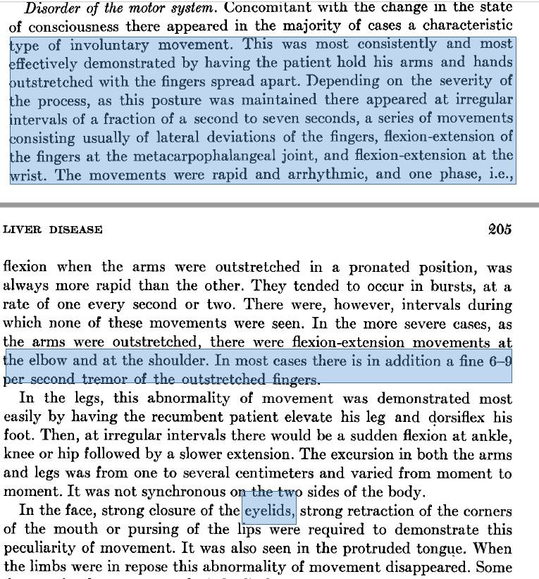 What is asterixis?Described~60 yrs ago by Adams/Foley Methods:60pts w/impending hepatic coma vs controlsFlapping flexion/extension, best @ thebut happens even 2 the lids! Has intervening tremor (mini-asterixis)Look 4 it while checking handgrip! #livertwitter1/4