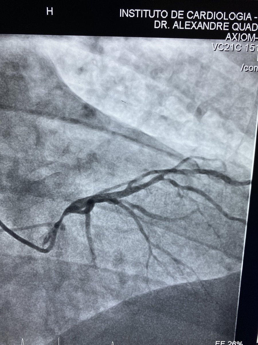 AlesqQuadros's tweet photo. Are EXCEL results aplicabble to this case?@lamelaspablo @GreggWStone @felixdamasds @rickytiago @maiafelipe08 @SVRaoMD @evandrofilhobr #cardiotwitter #RadialFirst https://t.co/JeEln0ao2O