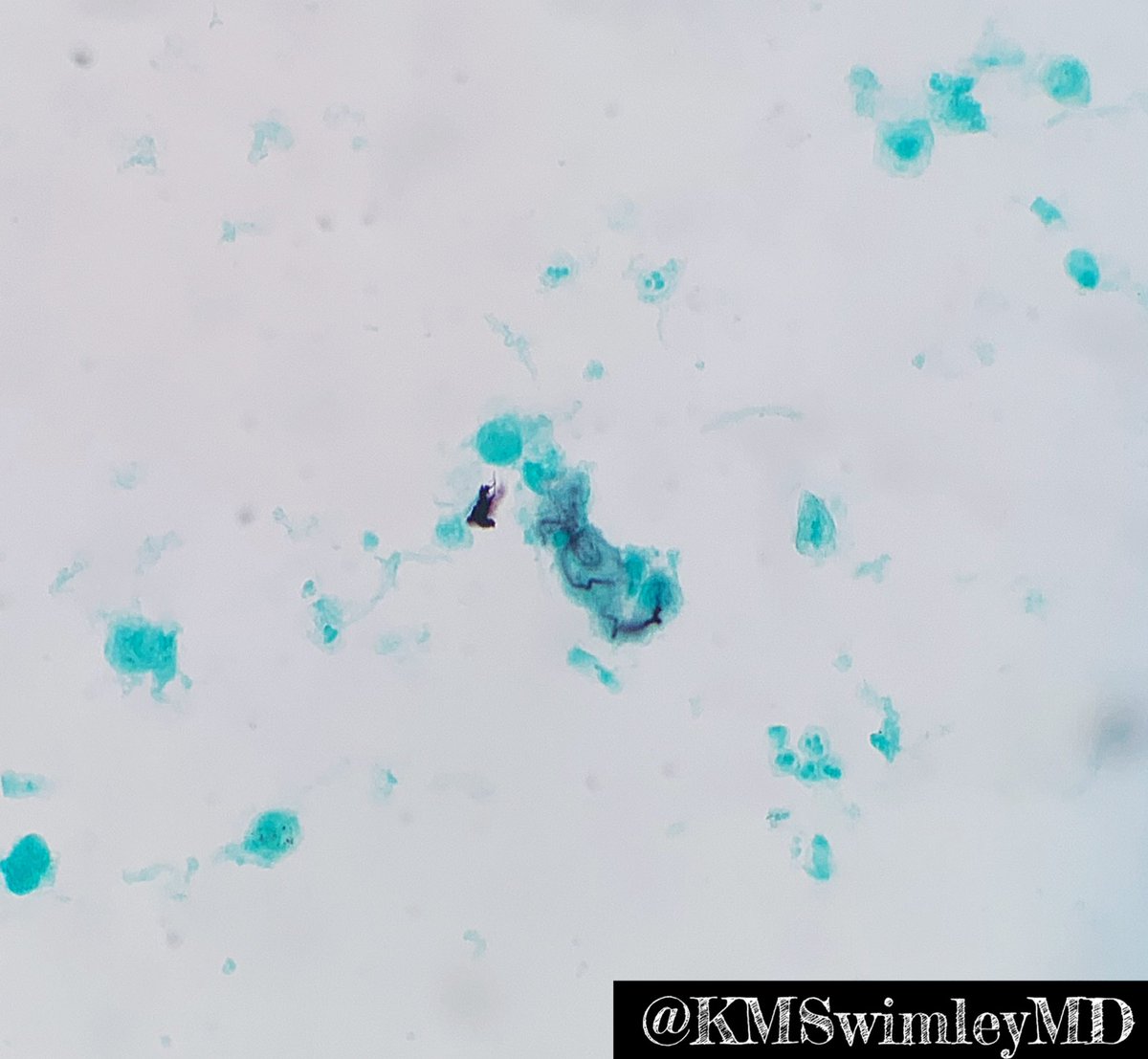 Curschmann’s spiral anyone? #cytopath #BAL #PathTwitter #Pathres