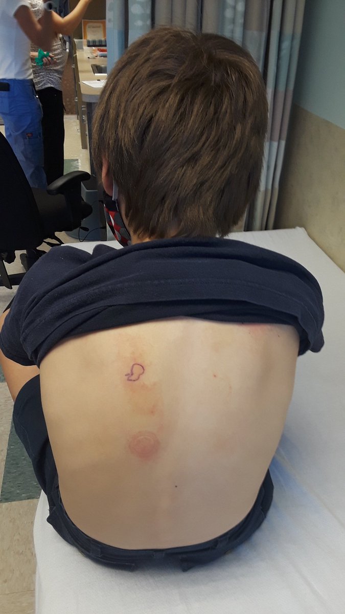 allergyheroes's tweet photo. Kiddo is officially done with the #PeanutPatch! In 2 weeks we have a #FoodChallenge to try an oral maintenance dose. We had lots of adhesion problems so the FDA ruling isn't surprising. (More thoughts to come.) Even so, it feels weird to be done. This has been 1/3 of his life! https://t.co/GQvuwGr3d1