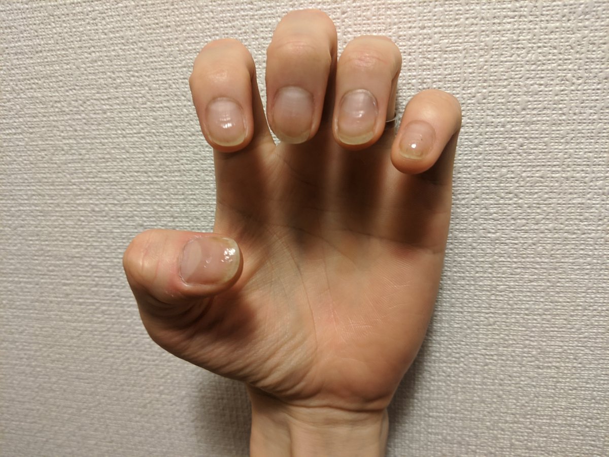 爪噛み男 Nail Biter 165日目 ベースコート様々 でもおかげで黄色い Day 165 Nail Base Coat Works Really Well And Makes Nails Yellow 爪噛み克服 深爪矯正 Stopnailbiting T Co Kytdlepv3f