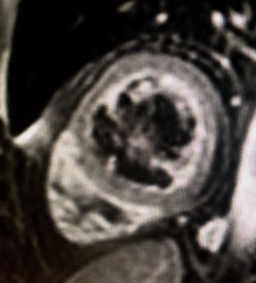 2/9 Bright signal isodense with fat (epicardial and SC fat) in inferior / inferolateral subepicardial wall (at 3-5 o’clock-disappears with fat suppression sequences - far right)  @JStojanovskaMD  @DrJenniferCo_Vu  @OKhaliqueMD  @AScatteia  @AKallifatidis  @vineetao17  @DmmOsmany