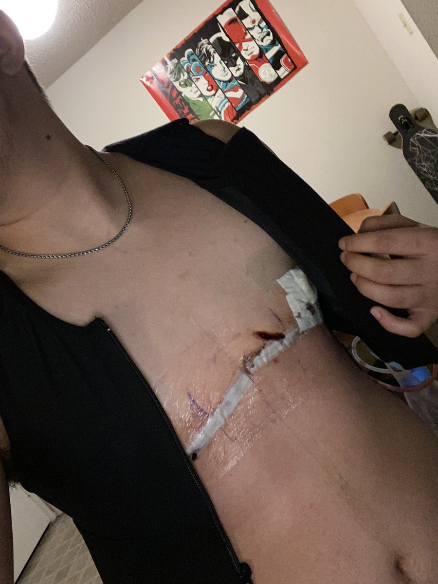 prettybasicgeek's tweet photo. One week post-op ( IK the pics are cringy 🤷‍♂️ https://t.co/ziYEM0Ho64