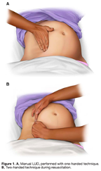 Leftward uterine displacement. If the uterine fundus is above the umbilicus, it’s big enough to cause aortocaval compression. Assign someone to stand on the patient’s right and push the uterus to the left OR stand on the left and pull the uterus toward the left. See diagram. 7/
