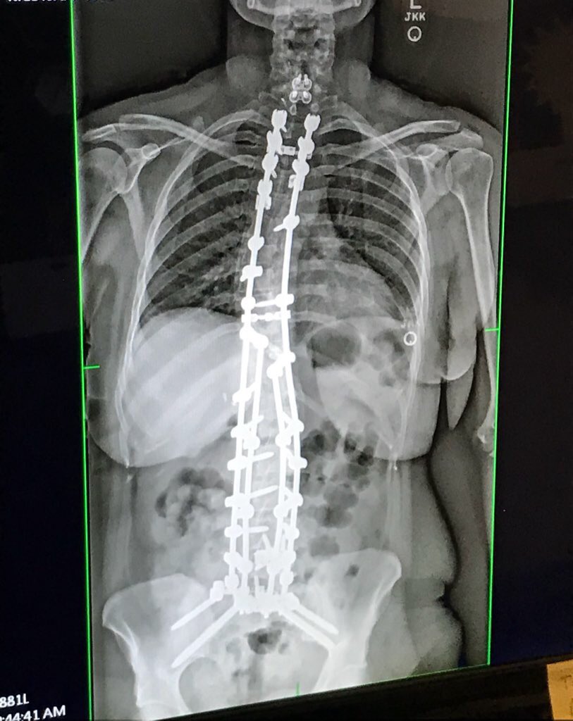 RScoliosis's tweet photo. @allisongill @dailybeanspod I am #HereForIT!!!
Mueller She Wrote is the first podcast I gave money to! π€
We used to chat often back in 2018 here at Twitter, but I had to take a break from my personal account. (Maybe Iβll write about it for your good news segment on DailyBeans)
Remember the #BootParty? https://t.co/n3CBKiZgH8