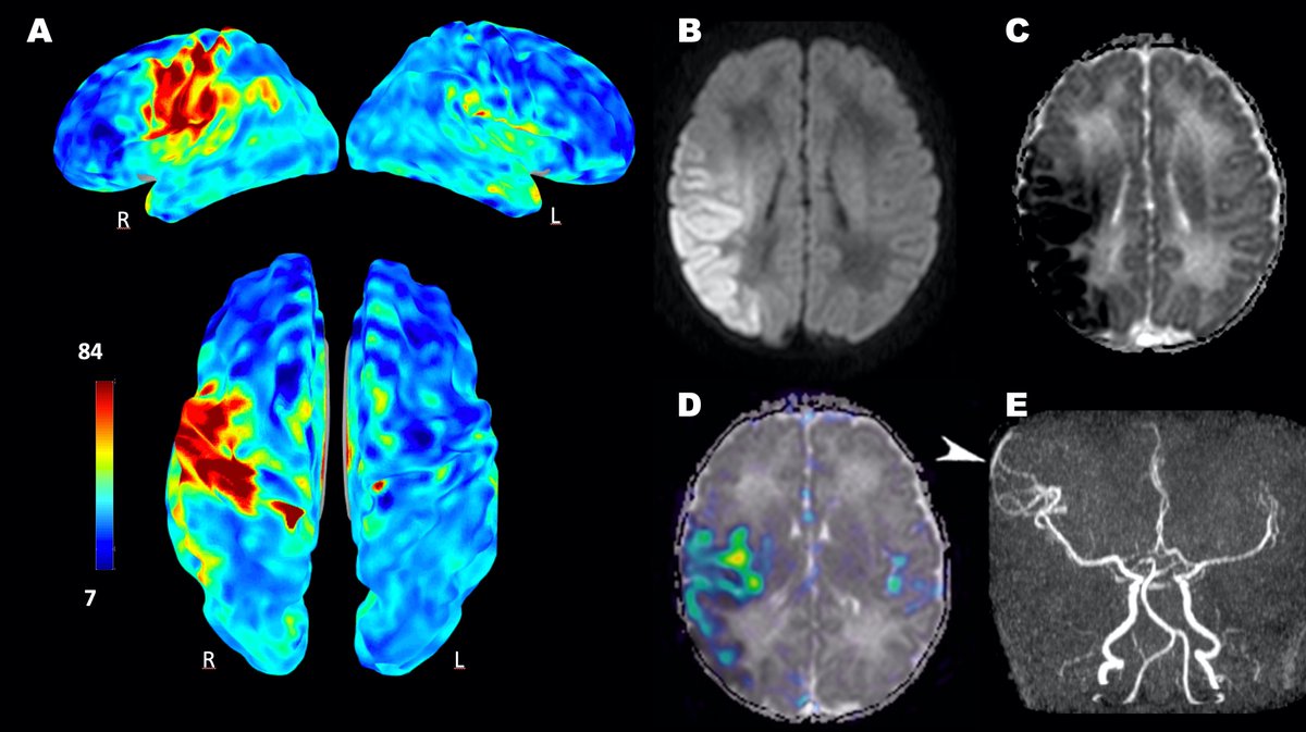 Domenico Tortora (@tortoradomenico) on Twitter photo Arterial spin labeling perfusion in neonates: new insights from a great techinque! sciencedirect.com/science/articl… & rdcu.be/b6bsy <a href="/MSavinaSeverino/">Mariasavina Severino</a> <a href="/AndreaRossi_NRX/">Andrea Rossi</a> <a href="/NRADjournal/">Neuroradiology</a> #pedineurorad #NeuroRad #PedsRad #radres #Neonates <a href="/ESNRad/">ESNR</a> Arterial spin labeling perfusion in neonates: new insights from a great techinque! sciencedirect.com/science/articl… & rdcu.be/b6bsy <a href="/MSavinaSeverino/">Mariasavina Severino</a> <a href="/AndreaRossi_NRX/">Andrea Rossi</a> <a href="/NRADjournal/">Neuroradiology</a> #pedineurorad #NeuroRad #PedsRad #radres #Neonates <a href="/ESNRad/">ESNR</a>