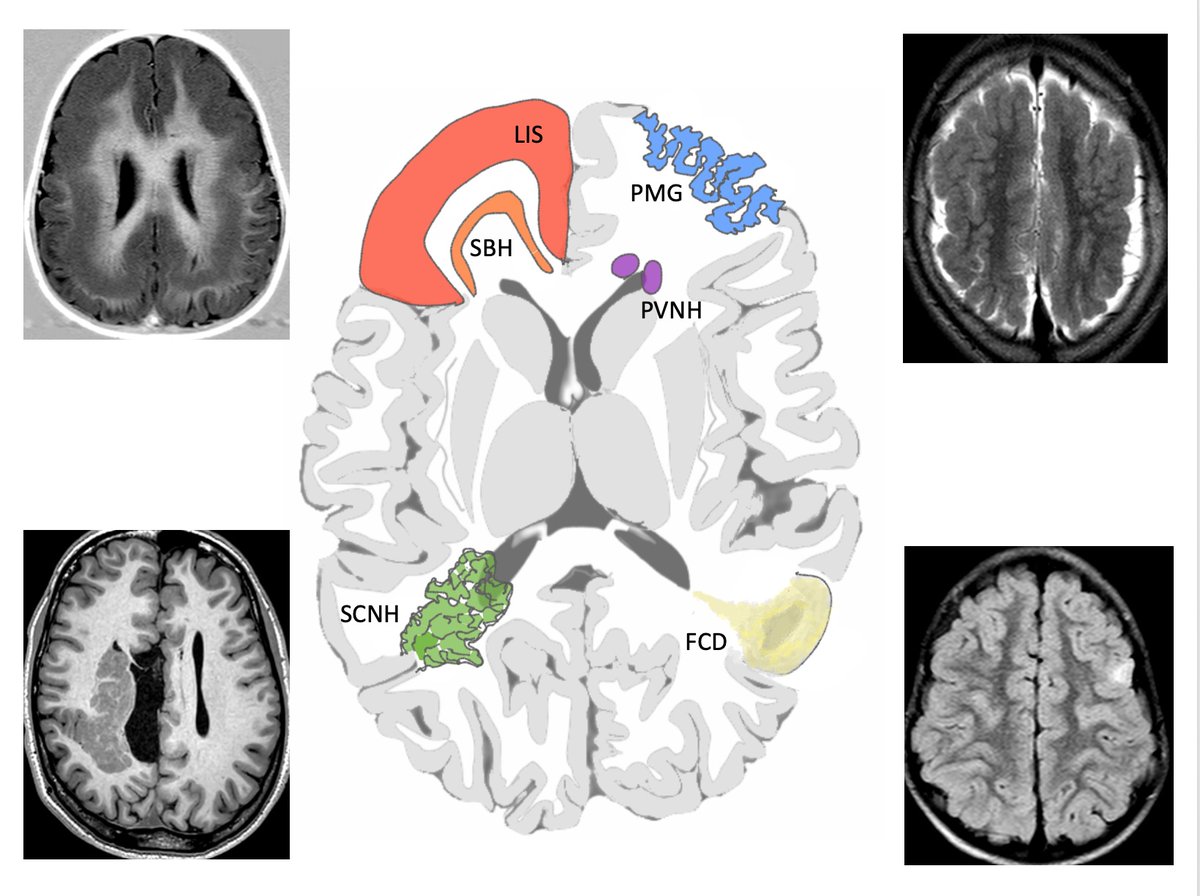 Mariasavina Severino (@msavinaseverino) on Twitter photo A great result from the imaging working group of the <a href="/neuro_mig/">neuro-MIG</a> COST action CA16118! academic.oup.com/brain/advance-… <a href="/GraziaMancini3/">Grazia Mancini</a> <a href="/AndreaRossi_NRX/">Andrea Rossi</a> <a href="/DrGeraldoFilipa/">Ana Filipa Geraldo</a> <a href="/TortoraDomenico/">Domenico Tortora</a> <a href="/drmankad/">Dr Kish Mankad</a> #COSTaction <a href="/Brain1878/">Brain</a> #PediNeurorad <a href="/ESNRad/">ESNR</a> #radres A great result from the imaging working group of the <a href="/neuro_mig/">neuro-MIG</a> COST action CA16118! academic.oup.com/brain/advance-… <a href="/GraziaMancini3/">Grazia Mancini</a> <a href="/AndreaRossi_NRX/">Andrea Rossi</a> <a href="/DrGeraldoFilipa/">Ana Filipa Geraldo</a> <a href="/TortoraDomenico/">Domenico Tortora</a> <a href="/drmankad/">Dr Kish Mankad</a> #COSTaction <a href="/Brain1878/">Brain</a> #PediNeurorad <a href="/ESNRad/">ESNR</a> #radres