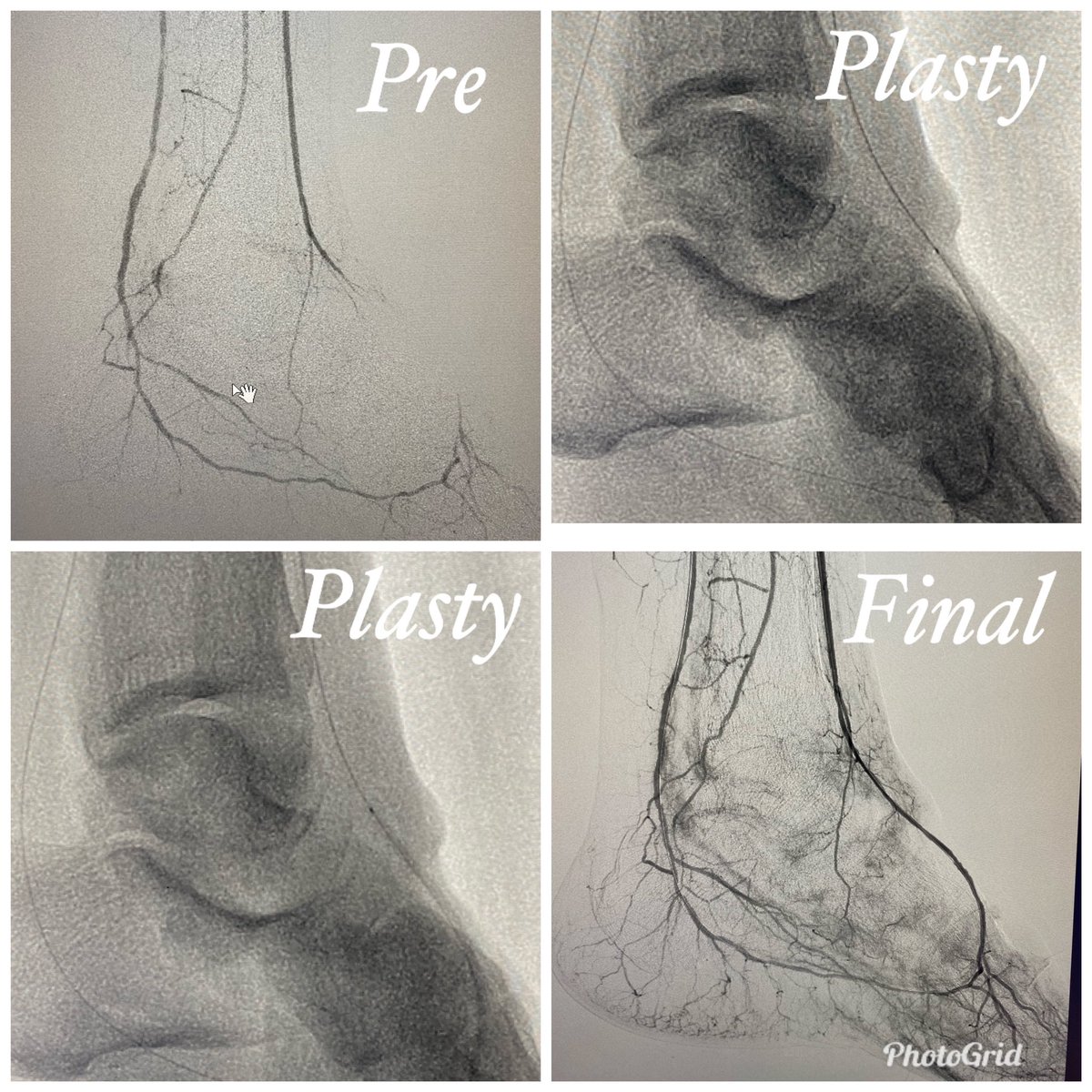 65 yo DM with no healing ulcer at toe amputation stump and #CLI treated by plantar arch reconstruction #pedalplantarloop. Good blush in foot post plasty. #CLIfighter @hospital_kims @ISVIRIndia @cirsesociety @SIRspecialists @SIRRFS