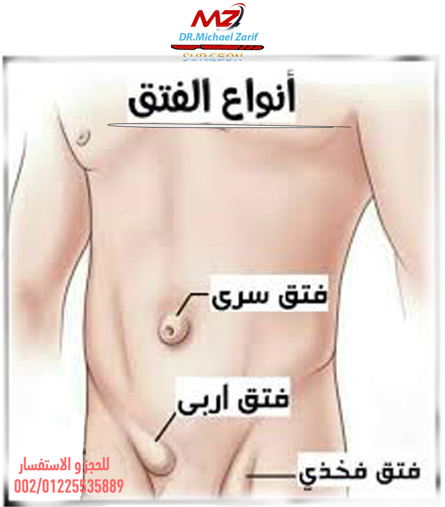 الزائدة الدودية بالانجليزي