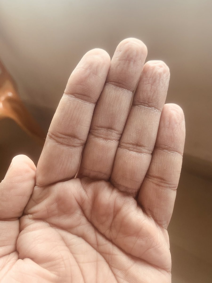 eyesurgeon9's tweet photo. My hands are older than me these days #glovedhands #COVID19 period https://t.co/KAiBY574hB
