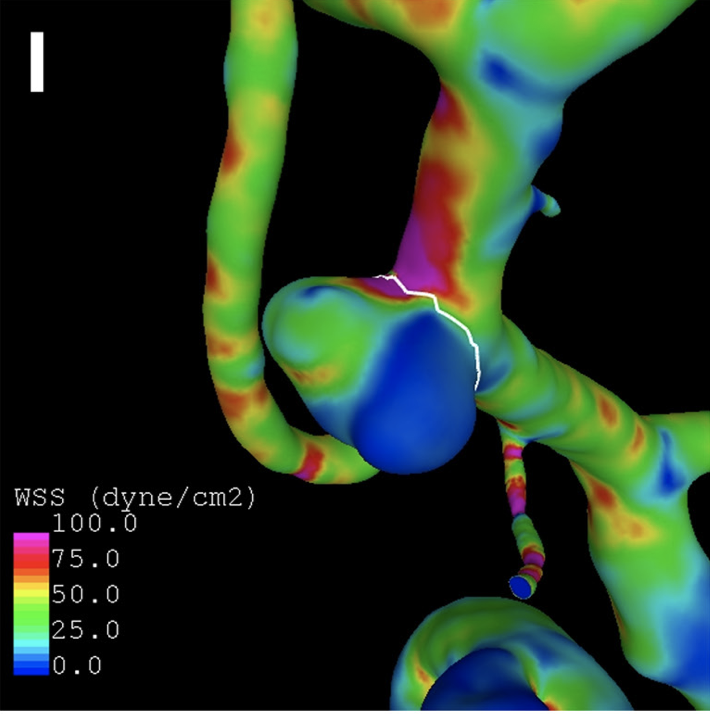NeuroVascGT's tweet photo. Seyedeh et al, Hemodynamic conditions that favor bleb formation in cerebral aneurysms. https://t.co/hOeEpPO5tg https://t.co/5qelRYGDyw