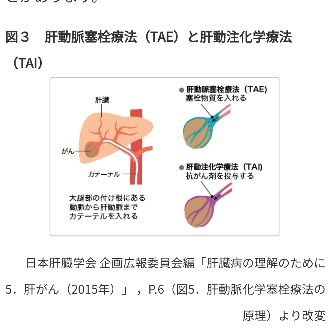 【裁断】肝動脈化学塞栓療法(TACE): 理論と実践ストラテジー 肝動脈化学塞栓療法(TACE) 理論と実践ストラテジー 新品本・書籍