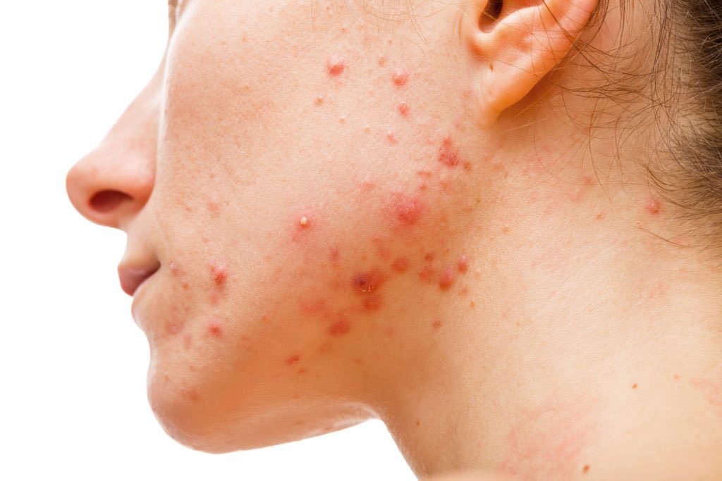 SIGNS YOUR PIMPLES ARE RELATED TO HORMONESIn my previous thread, I ada explain about hormonal acne. To recap, hormonal acne berkait rapat dengan our hormones. There are several signs that your pimples are related to hormones. THREAD