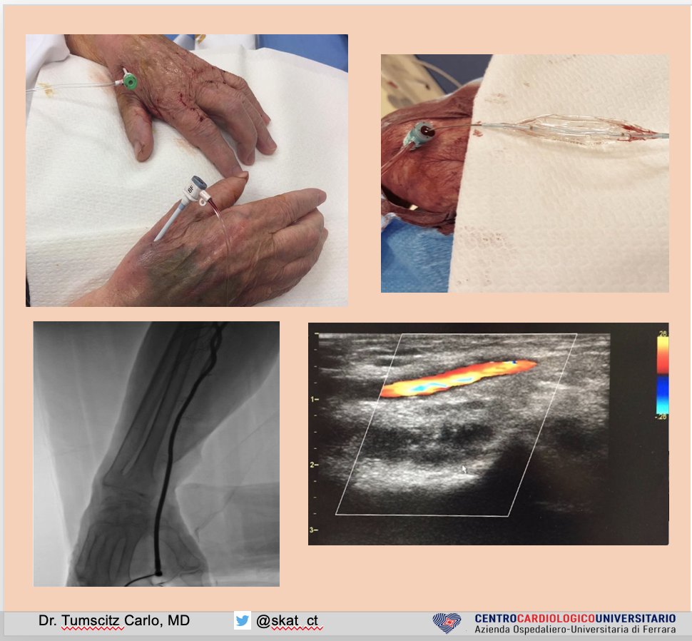 Finally published in CCI our results of #dTRA #RadialBAV: 100% success rate, no vascular adverse events, RAO 1/10 pts. Thanks to <a href="/AnnamariaDices1/">Annamaria Di cesare</a>!  <a href="/Costa_F_8/">Francesco Costa</a> <a href="/evandrofilhobr/">Evandro Martins F. MD</a> <a href="/saia_francesco/">Francesco Saia</a> <a href="/aspergian1/">Jack Hall</a> <a href="/mmamas1973/">Mamas A. Mamas</a> <a href="/ISeropianMD/">Ignacio Seropian MD</a>  onlinelibrary.wiley.com/share/author/X…