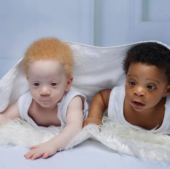 IamMzilikazi's tweet photo. LOVE and RESPECT: Albinism isn’t a curse but a genetic condition 5 https://t.co/l9VtWpazy2