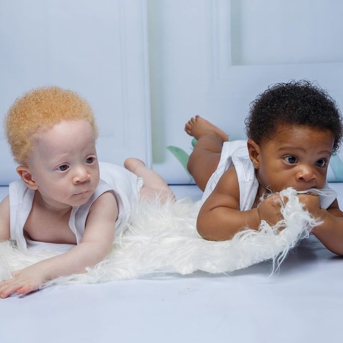 IamMzilikazi's tweet photo. LOVE and RESPECT: Albinism isn’t a curse but a genetic condition 5 https://t.co/l9VtWpazy2