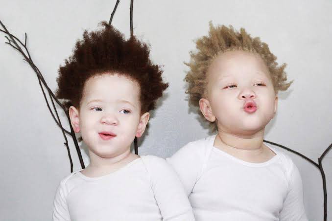 IamMzilikazi's tweet photo. LOVE and RESPECT: Albinism isn’t a curse but a genetic condition 5 https://t.co/l9VtWpazy2