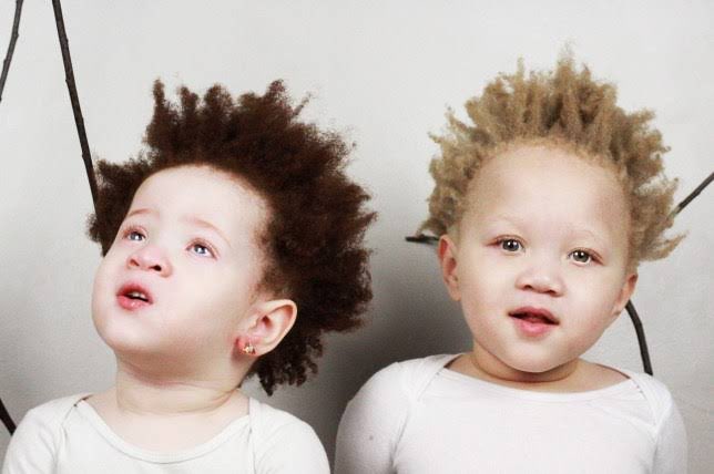 IamMzilikazi's tweet photo. LOVE and RESPECT: Albinism isn’t a curse but a genetic condition 5 https://t.co/l9VtWpazy2