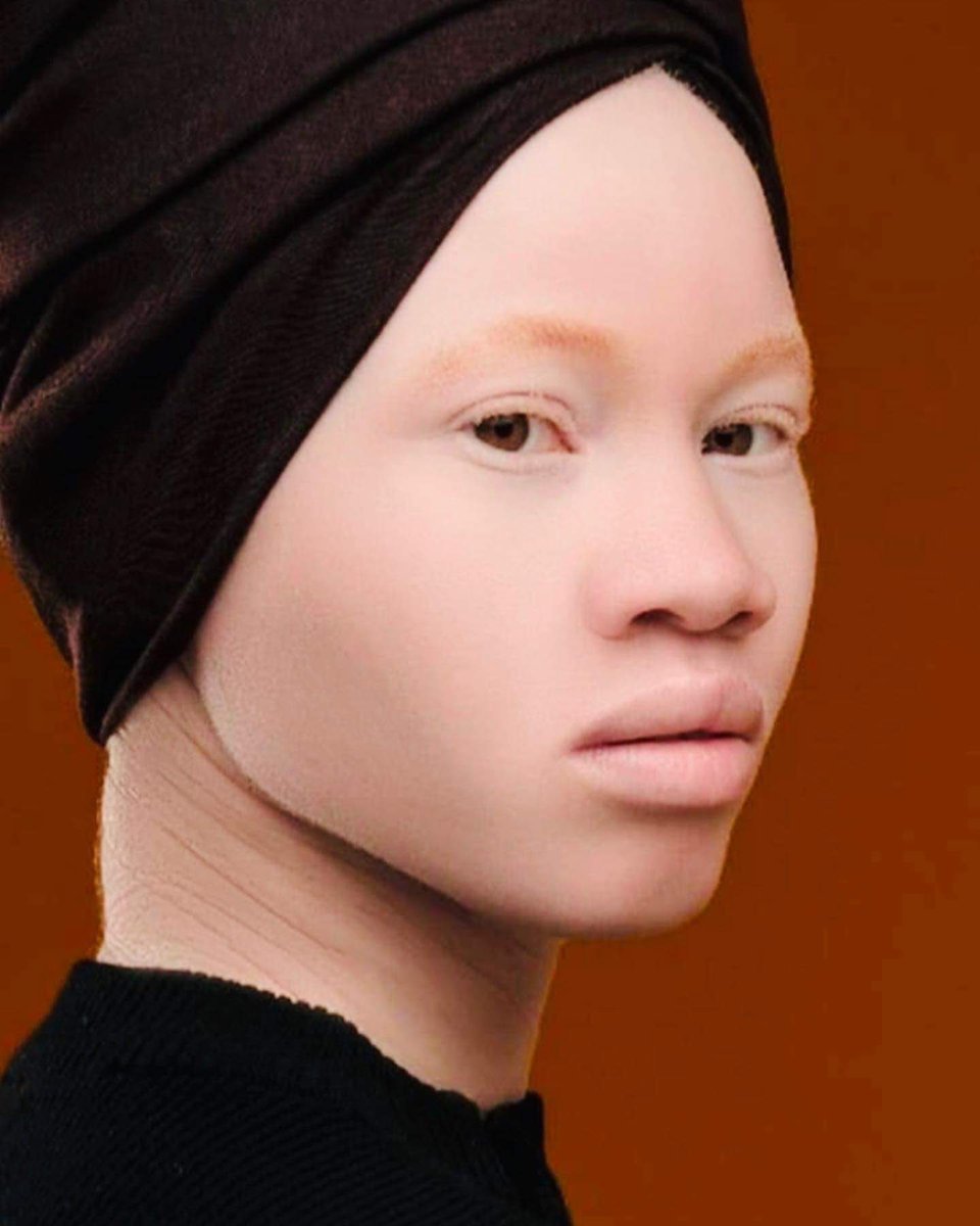 IamMzilikazi's tweet photo. LOVE and RESPECT: Albinism isn’t a curse but a genetic condition 20 https://t.co/3kcyjbSn5n