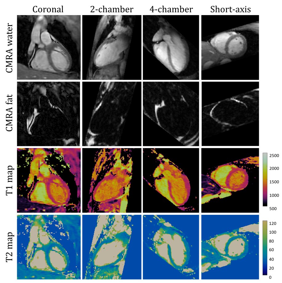 Join us today at the #ismrm2020 Q&amp;A on Multi-Contrast &amp; High Dimensionality CMRI at 15:20 UTC if you're interested in "3D Whole-heart isotropic-resolution Motion Compensated Joint T1/T2 Mapping" (ww5.aievolution.com/ism2001/index.…)
<a href="/KCL_CardiacMR/">KCL Cardiac MRI</a>
<a href="/KingsImaging/">Biomedical Engineering & Imaging Sciences</a> 
<a href="/rbotnar/">Rene Botnar</a>