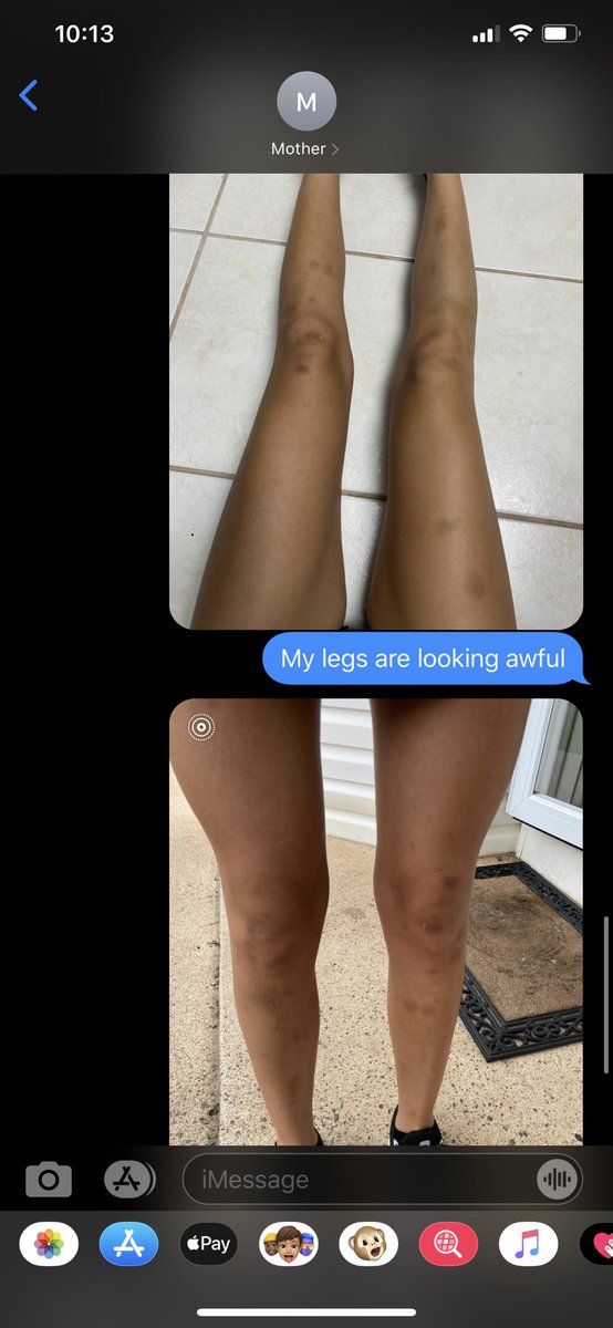 TaylorP128's tweet photo. My iron is low so I’ve been bruising out of nowhere lately and sent a pic to my mom and the only thing she had to say was that my legs looked thin  ? No Christy I look like I was in a full car accident but okay https://t.co/g9peeznOaN