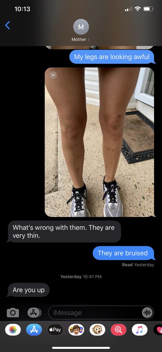 TaylorP128's tweet photo. My iron is low so I’ve been bruising out of nowhere lately and sent a pic to my mom and the only thing she had to say was that my legs looked thin  ? No Christy I look like I was in a full car accident but okay https://t.co/g9peeznOaN