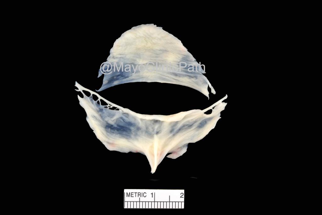 Mayo Clinic Pathology (@mayoclinicpath) on Twitter photo HEART Thursday w/ <a href="/MelanieBoisMD/">Melanie Bois</a>!
49-yo man s/p resection of pictured specimen. Based on the diagnosis, he and his first degree family are at risk for:
A.Cardiac amyloidosis
B.Chronic pericarditis
C.Ascending aortic dilatation
D.Pulmonary hypertension
E.Mitral stenosis HEART Thursday w/ <a href="/MelanieBoisMD/">Melanie Bois</a>!
49-yo man s/p resection of pictured specimen. Based on the diagnosis, he and his first degree family are at risk for:
A.Cardiac amyloidosis
B.Chronic pericarditis
C.Ascending aortic dilatation
D.Pulmonary hypertension
E.Mitral stenosis