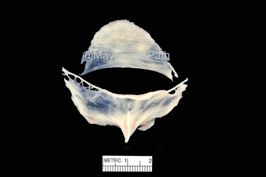 HEART Thursday w/ @MelanieBoisMD! 49-yo man s/p resection of pictured specimen. Based on the diagnosis, he and his first degree family are at risk for: A.Cardiac amyloidosis B.Chronic pericarditis C.Ascending aortic dilatation D.Pulmonary hypertension E.Mitral stenosis