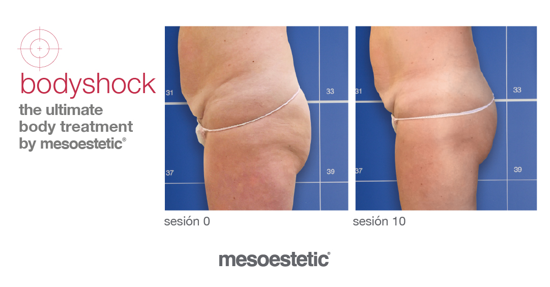 mesoestetic_ES's tweet photo. #bodyshock · antes y después de un levantamiento de glúteos y aumento de firmeza. La combinación del tratamiento con el uso de productos bodyshock domiciliarios desde la primera sesión, es clave para lograr una mayor eficacia. Más > https://t.co/kO0QqLE8rY https://t.co/WoIGJ3asMO