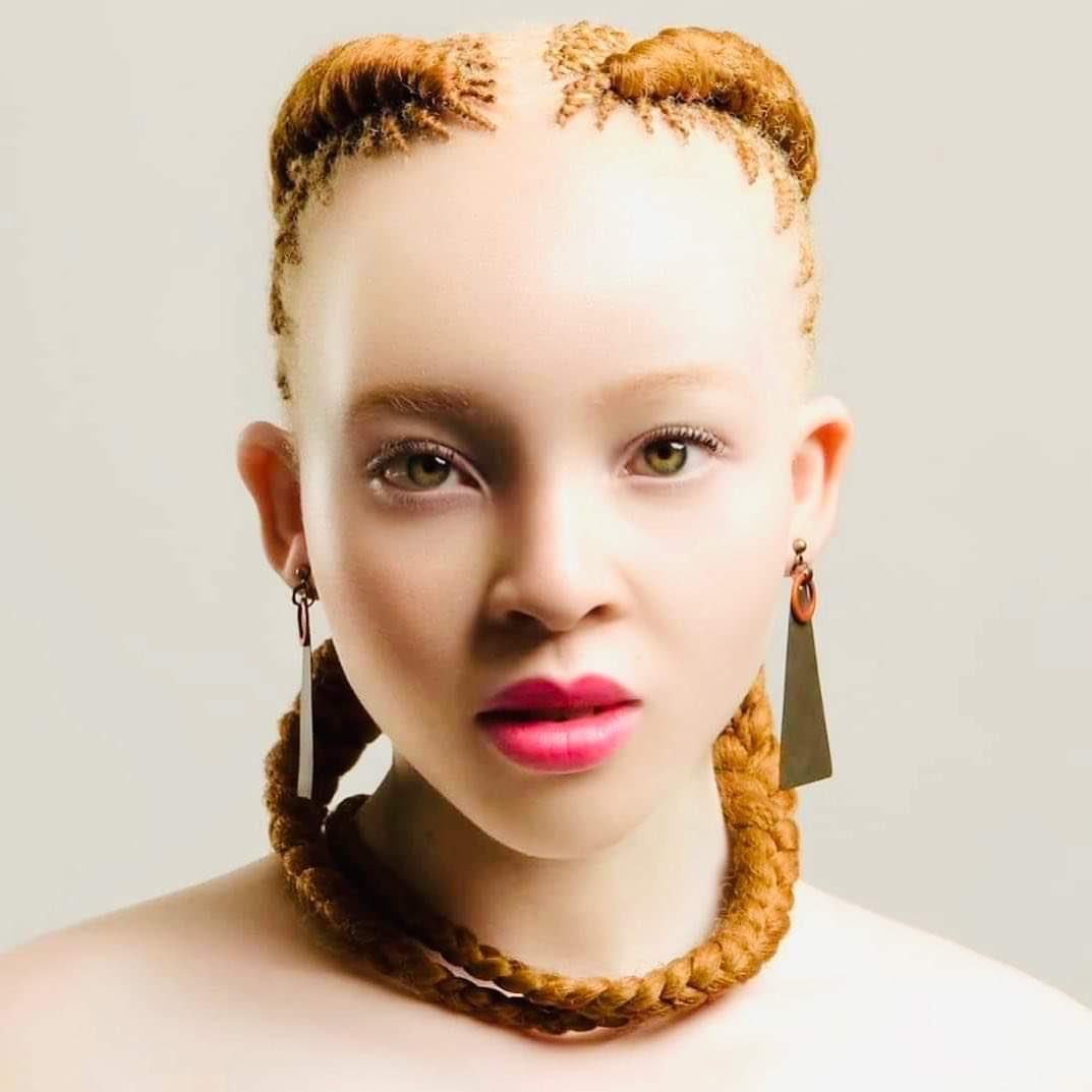African Albino
