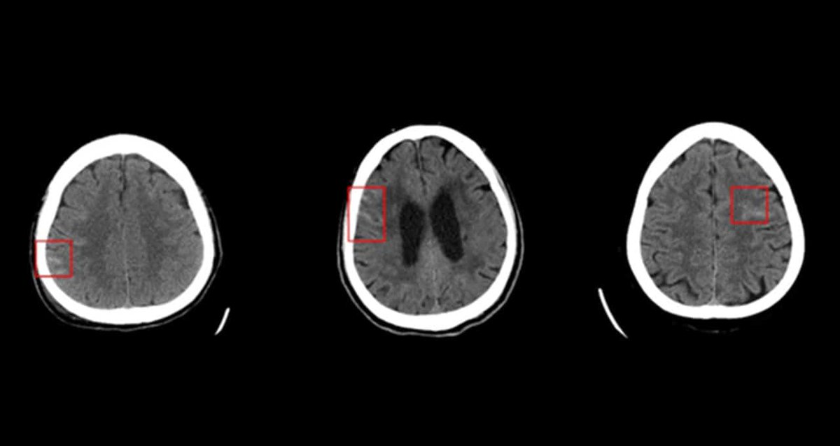 HubBucket's tweet photo. #Deep01 a Taiwan-based #MedTech company develops an #ArtificialIntelligence - #AI-based #MedicalImaging #Software optimized on @NVIDIA GPUs to help #Physicians diagnose bleeding around the brain.
🖥️https://t.co/i5zSNNAzCP | @NVIDIAAI
@HubBucket @HubMedX @ProsumerSoft https://t.co/yIqgig0frI