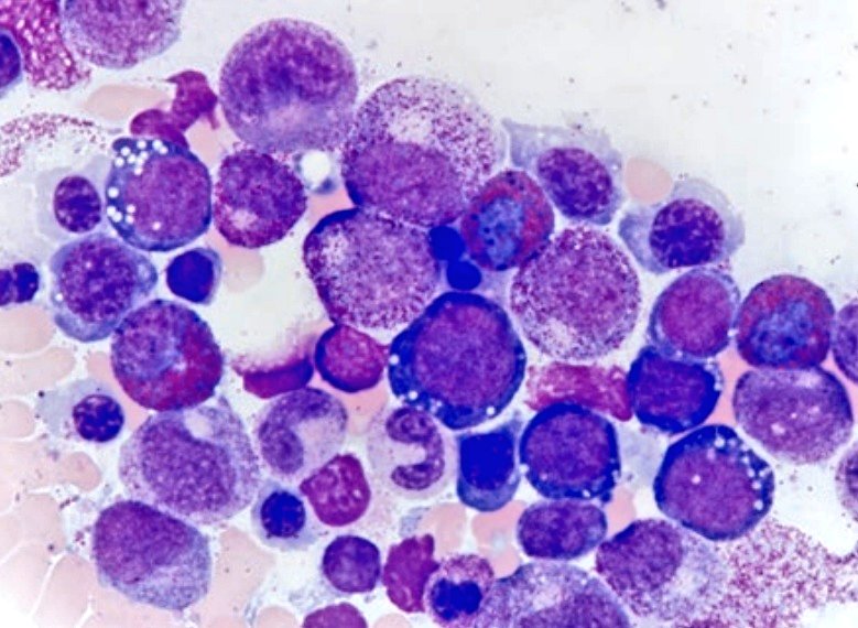 Drshalini01's tweet photo. A 33 year female with erythroid hyperplasia and cytoplasmic vacuolations in both erythroid and granulocytic precursors.Dysplastic changes mimicking mds.
Copper deficiency. #hemepath #pathtutorial https://t.co/NtK2zMzahV