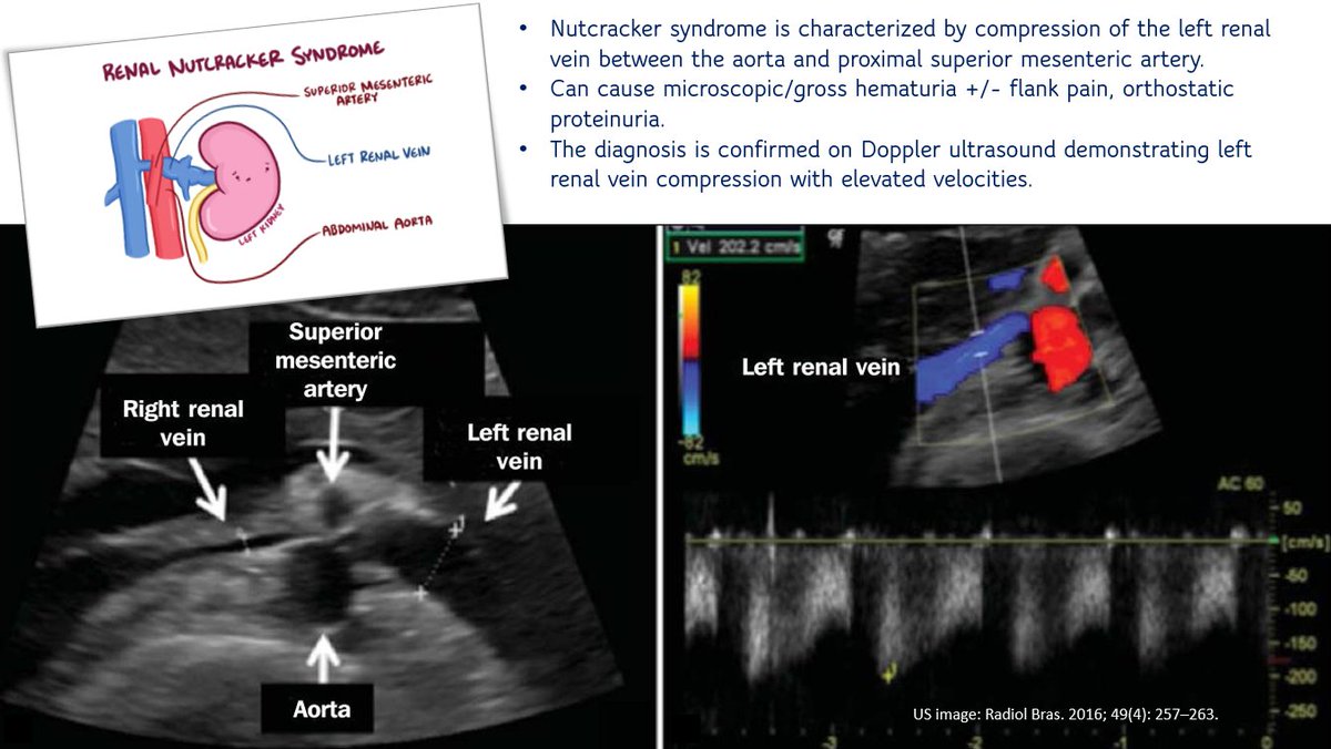 Nutcracker Syndrome Ultrasound