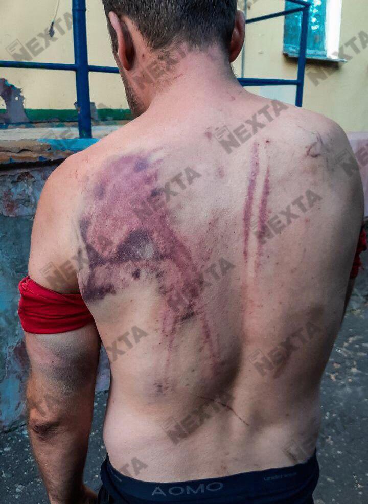 [GRAPHIC CONTENT] Multiple hematomas. But at least they are alive. Meanwhile, Minister of Interior Karaev said on state TV that he takes responsibility and apologizes for the injuries of random people at the protests