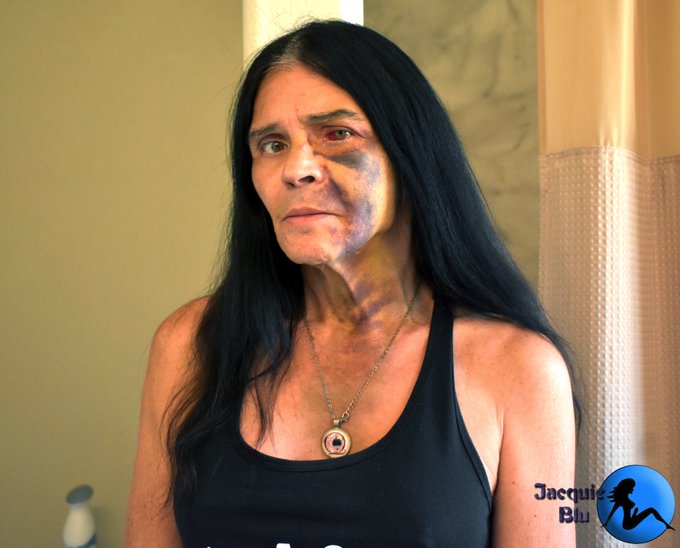 FACIAL UPDATE: (Looking a bit angry, huh?)  DAY 8  Finally some swelling has gone down, bruising has<a href="/tag/apclips"class="tags"><span>#apclips</span></a>