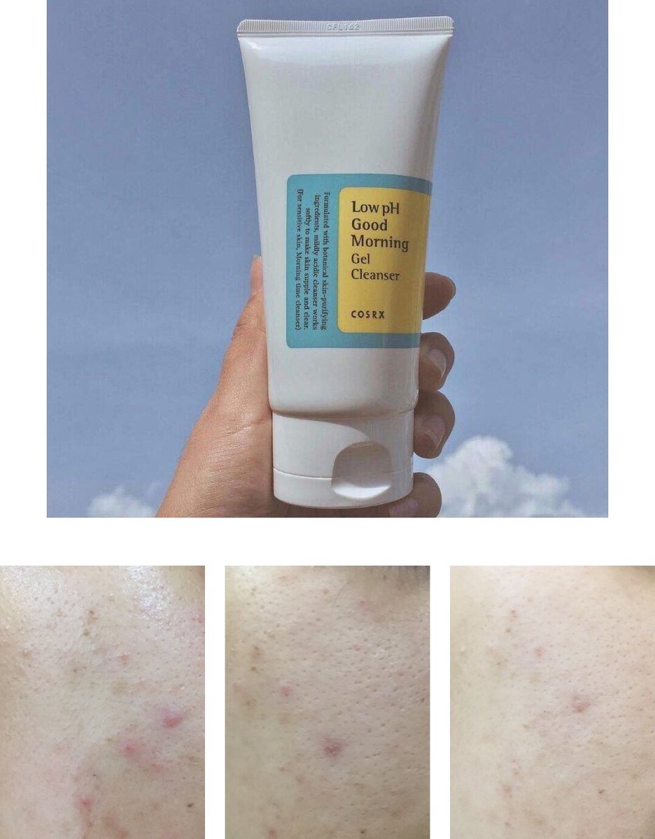 AthenaBeauty1's tweet photo. Hormonal Acne because of woman problem every month 😅. Don’t worry and keep using the same routine skincare but most importantly don squeeze it yaaa https://t.co/pPbZn33KCw