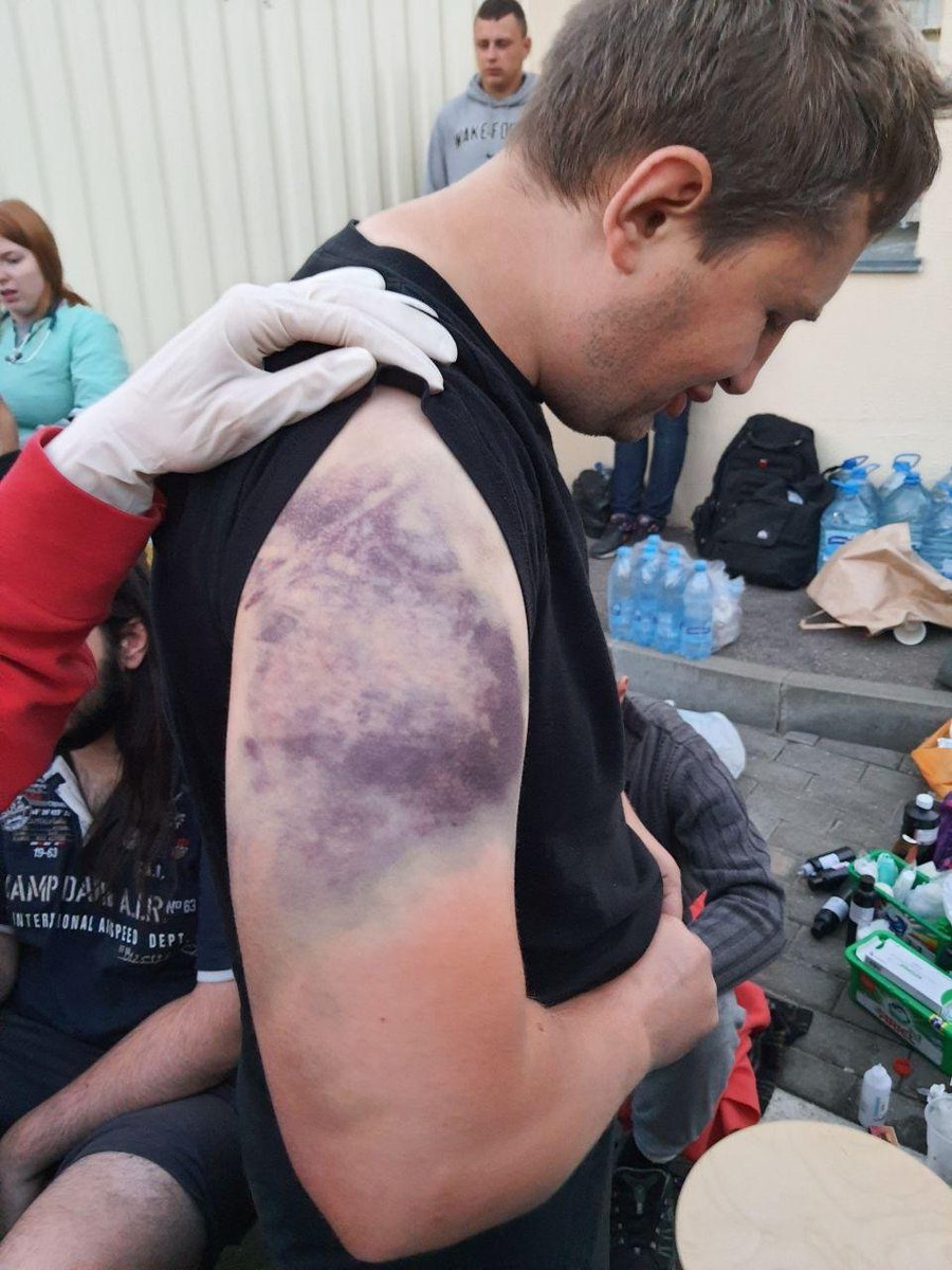 alex_kokcharov's tweet photo. More photos of injuries from those released from detention centre in #Minsk, #Belarus, following several days of torture, beatings and overcrowded conditions. 

This police brutality is happening in Europe in 2020.

Read report about this in Russian: https://t.co/Rb6PP2SD9r https://t.co/XjUPyCr76K