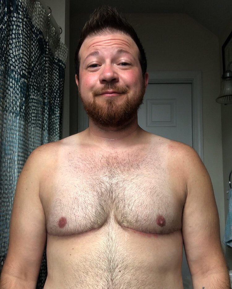 RonnocK0412's tweet photo. This is 6 weeks post op! It feels great to be free of a binder and to move towards getting more acquainted with my new chest and how it shapes my view of this vessel I’m in #ftm #translife #topsurgerypostop https://t.co/UvDCBjdTwm