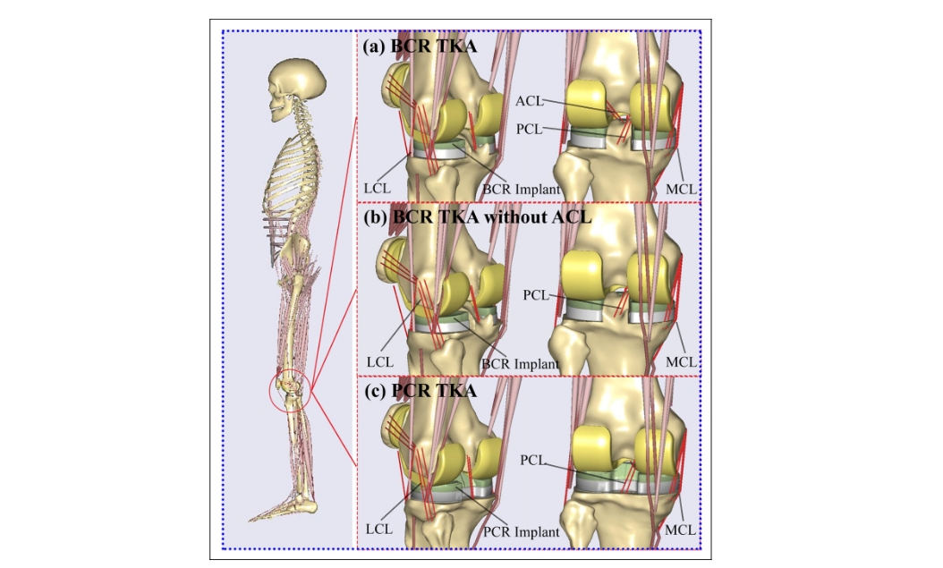 TechAnyBody's tweet image. New study titled:
&quot;Leveraging subject-specific musculoskeletal modeling to assess effect of ACL retaining TKA&quot;
conta.cc/30Vk7WL
#AnyBodyModelingSystem #KneeAthroplasty #KneeImplants