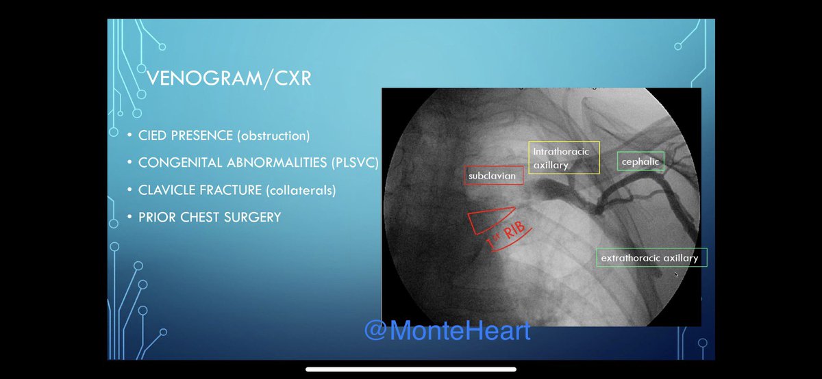 MonteHeart's tweet photo. TGIF! Starting the morning with a talk on-Venous access, procedural success and lead failure, for implantable devices- by stellar #MonteEP fellow @NicoTarantinoMD.
By the fellows for the fellows! 💪🏻
@LuigiDiBiaseMD @JorgeERomeroMD @DavidFBricenoMD @akhilparashar https://t.co/GI8ECg4ZhB