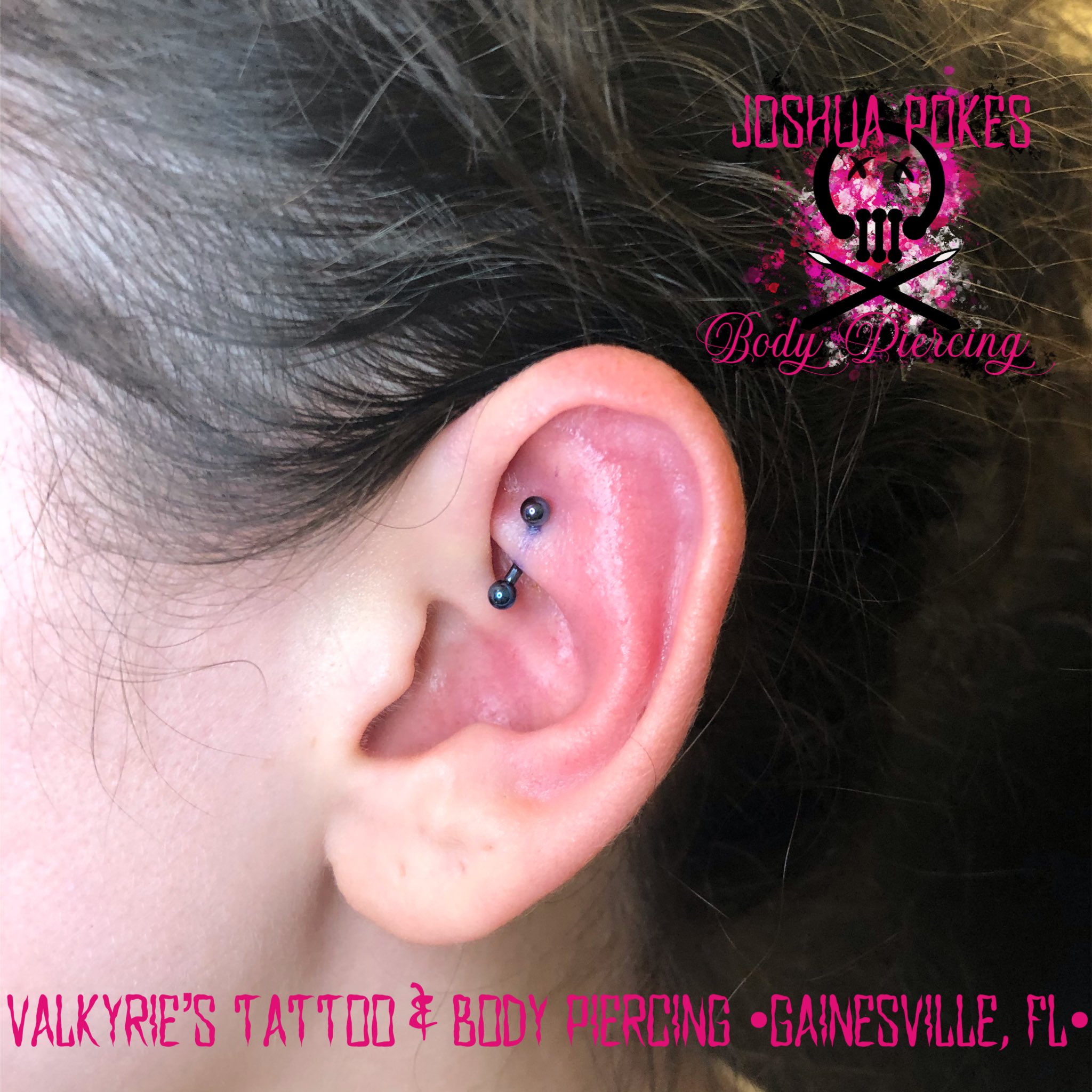 Rook Piercing Keloid