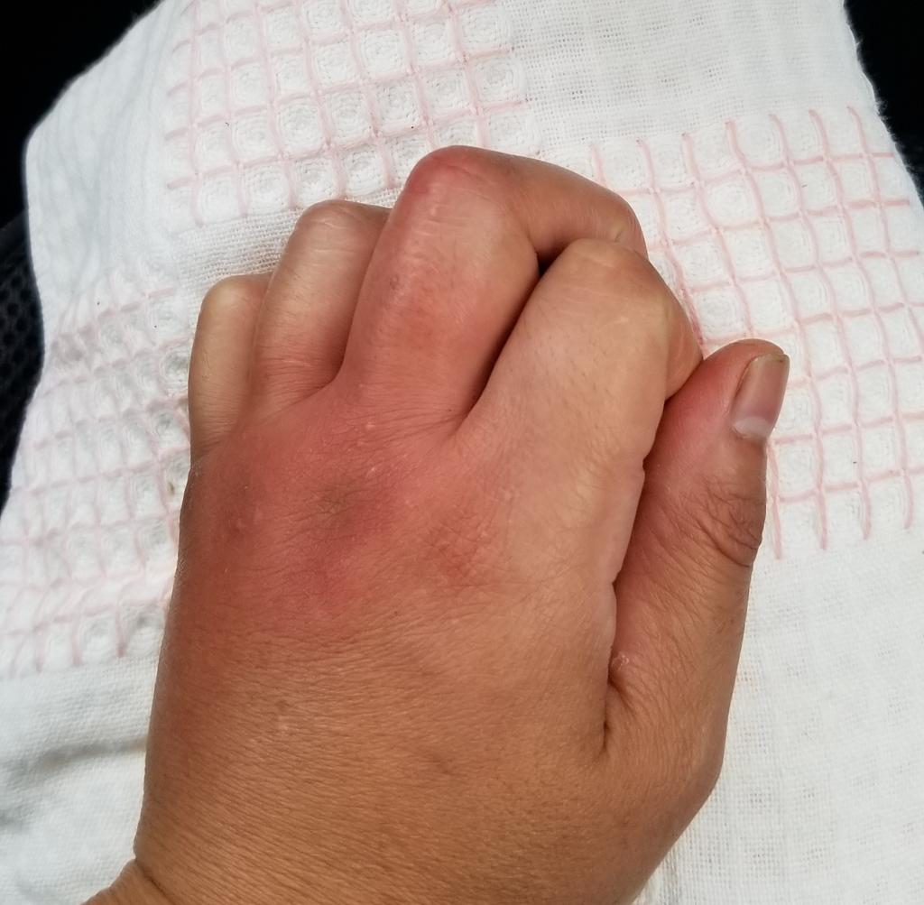ハチ刺され ハチ刺され