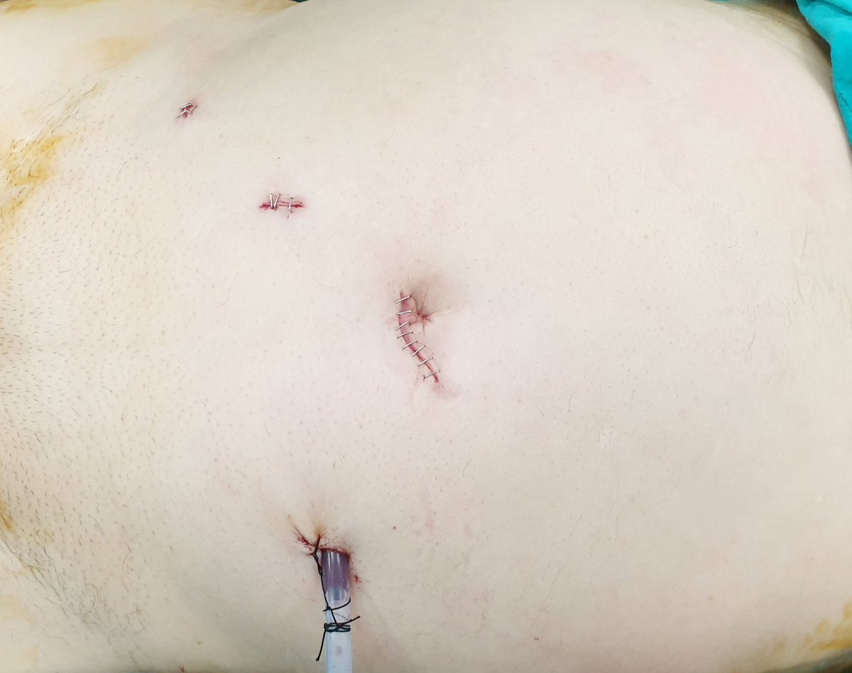 Today case; 68 yo male, 5/12 gleason 3+3 #Laparoscopic extraperitoneal #radical #prostatectomy , #nervesparing