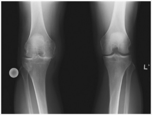 Imagen: Radiografía de osteoartritis severa en la rodilla derecha.