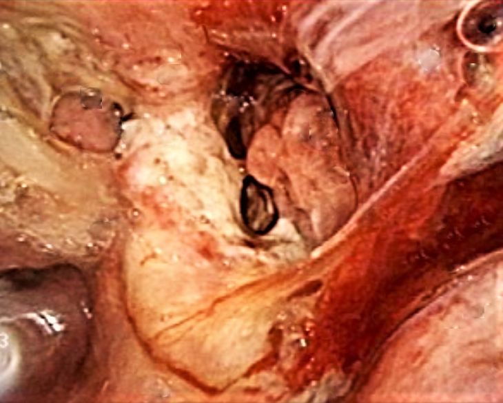 Wegener's granulomatosis. Nasal cavity, biopsy. HE, MRI (T1-Gd) and endoscopy(nasal cavity).
